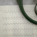 wide complex tachycardia