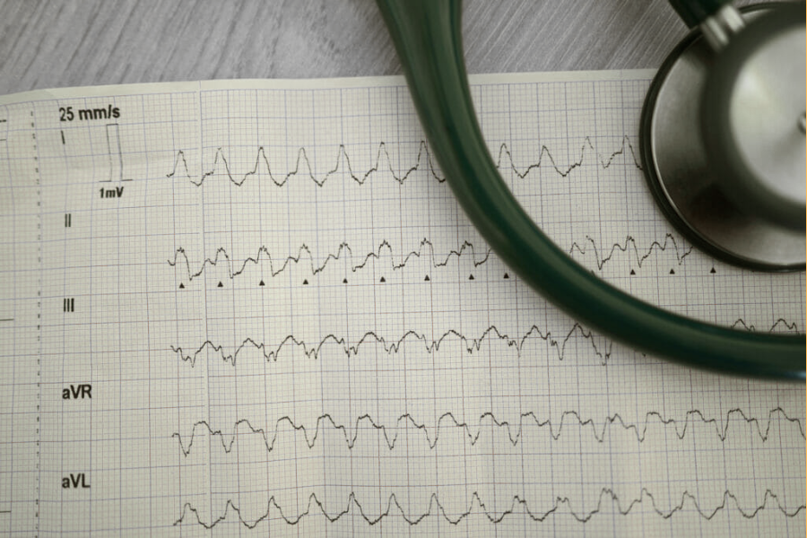 wide complex tachycardia